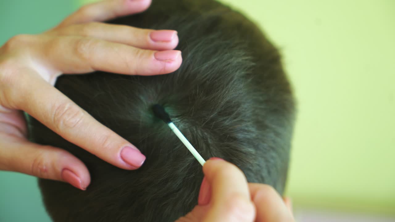 Little boy with chickenpox. Mother applying antiseptic solution to rash. Home treatment.