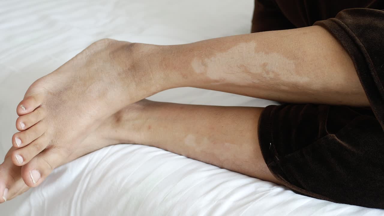 vitiligo en la pierna de una persona