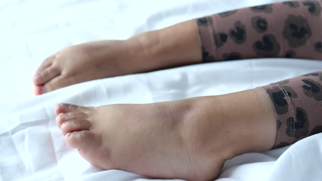 hinchazón de los tobillos en un niño