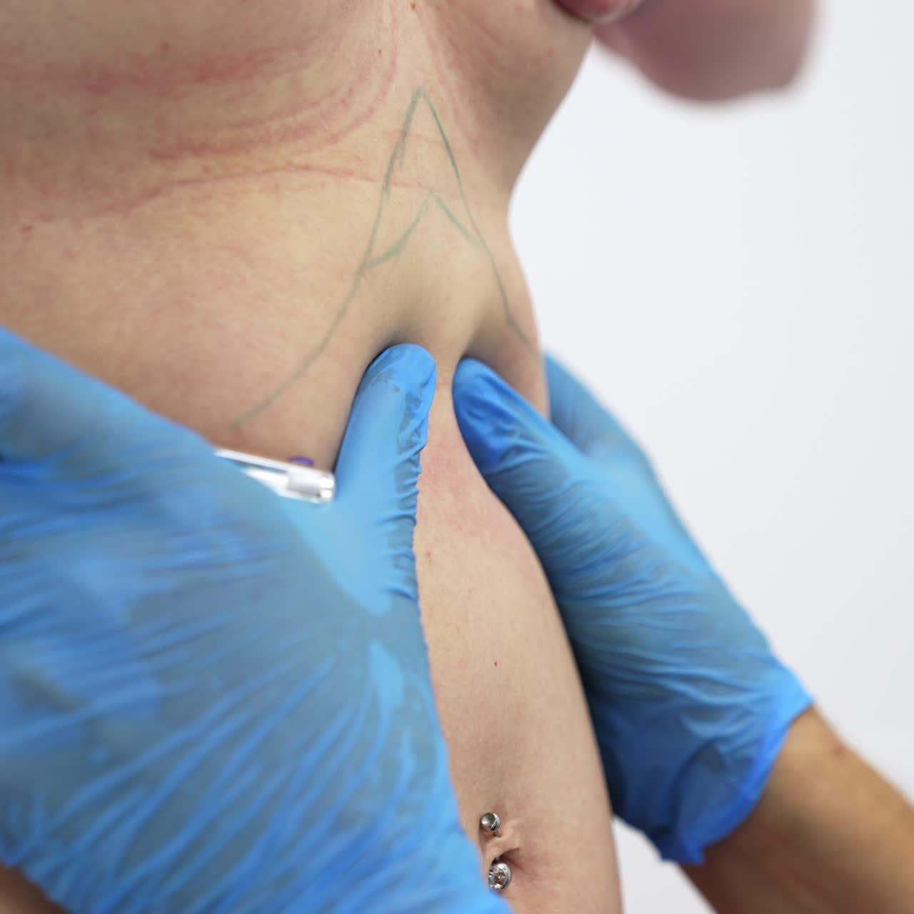 Hands in blue latex gloves draw lines on a belly of woman. Patient preparation for abdominoplasty. Close up