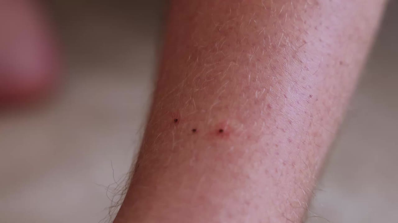 3 ticks creating red marks where they have entered a mans leg
