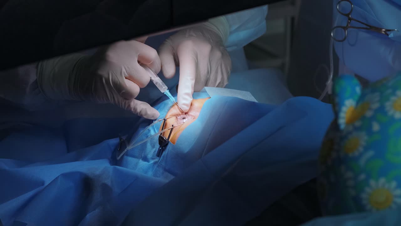 Correzione della vista con il laser. Un paziente e un team di chirurghi nella sala operatoria durante un intervento di chirurgia oftalmica. Divaricatore palpebrale. Trattamento Lasik. Paziente sotto copertura sterile