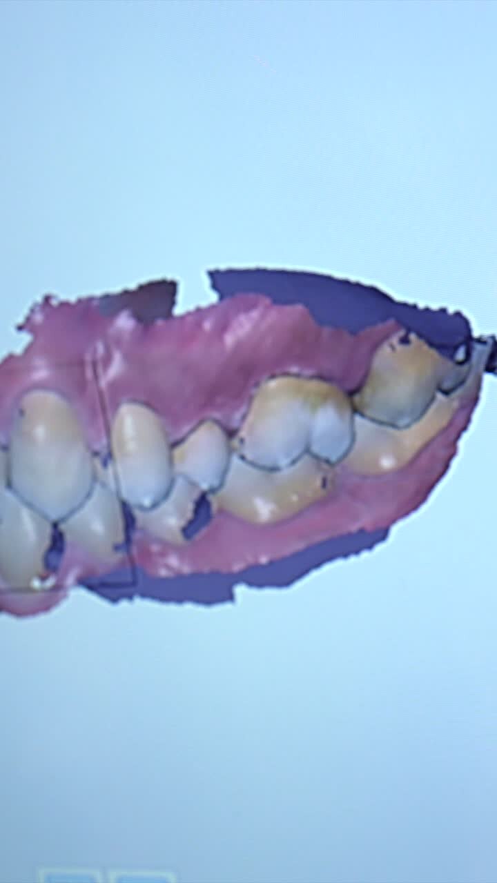 Dental scan of teeth