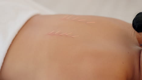 acupuntura, spa asiático y masaje de bienestar ayuda