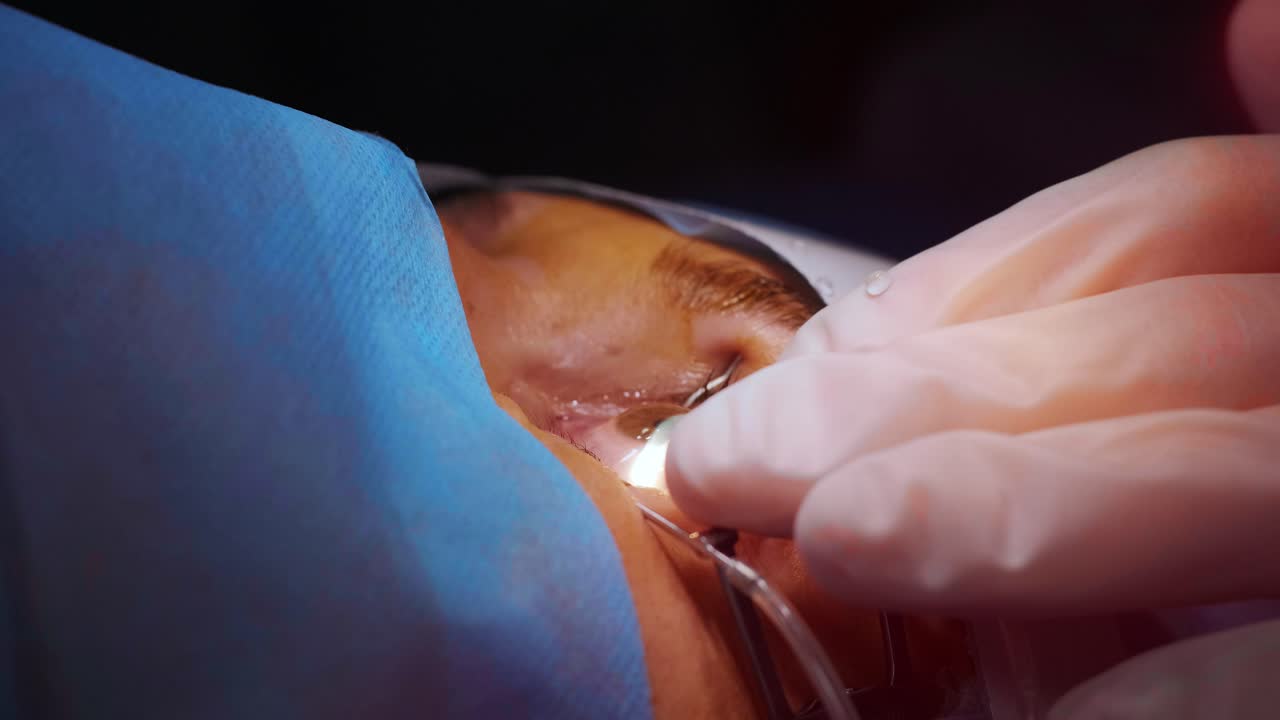 레이저 시력 교정: 안과 수술 중에 수술실에 있는 환자와 수술팀; 눈꺼풀 스럼; 라식 치료; 불임 개 아래의 환자