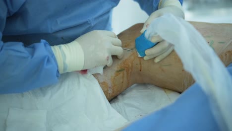 leg ulcer wound in treatment for varicose veins in phlebology procedure. bonding of veins using bioglue