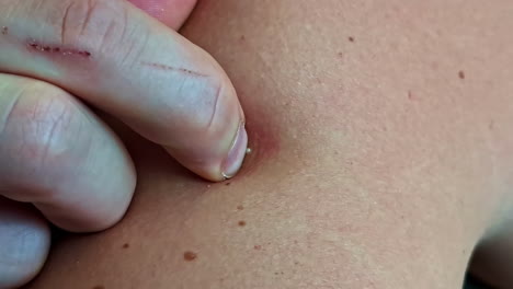 close up of a person popping a pimple and removing a whitehead from skin with fingers, scraping it off, red inflamed scratch