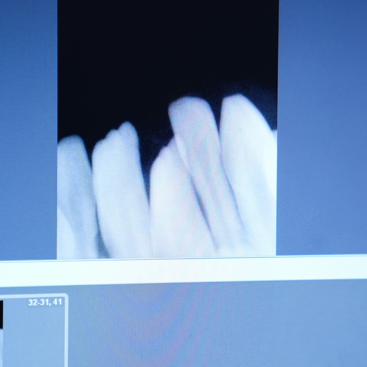 不揃いの歯のレントゲン写真。コンピュータ画面に表示された不適合な入れ歯のフィルム。クローズアップ。