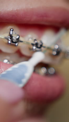 Cleaning Braces with Interdental Brush