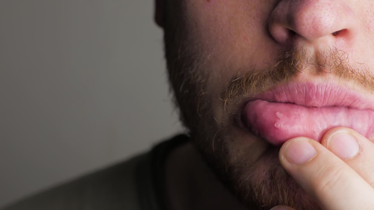 an aphtha oral inflammation on the gums