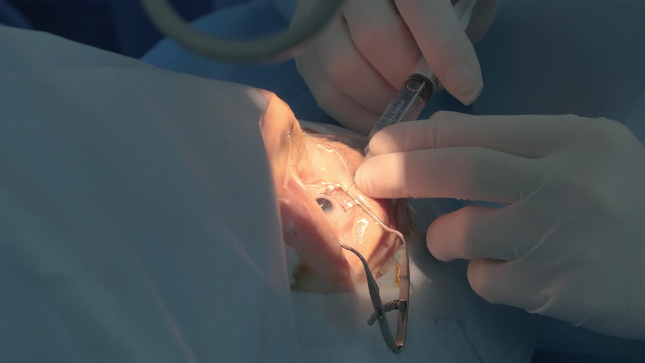 cirugía de cataratas de cerca. cirujano que opera cataratas oculares en cirugía hospitalaria