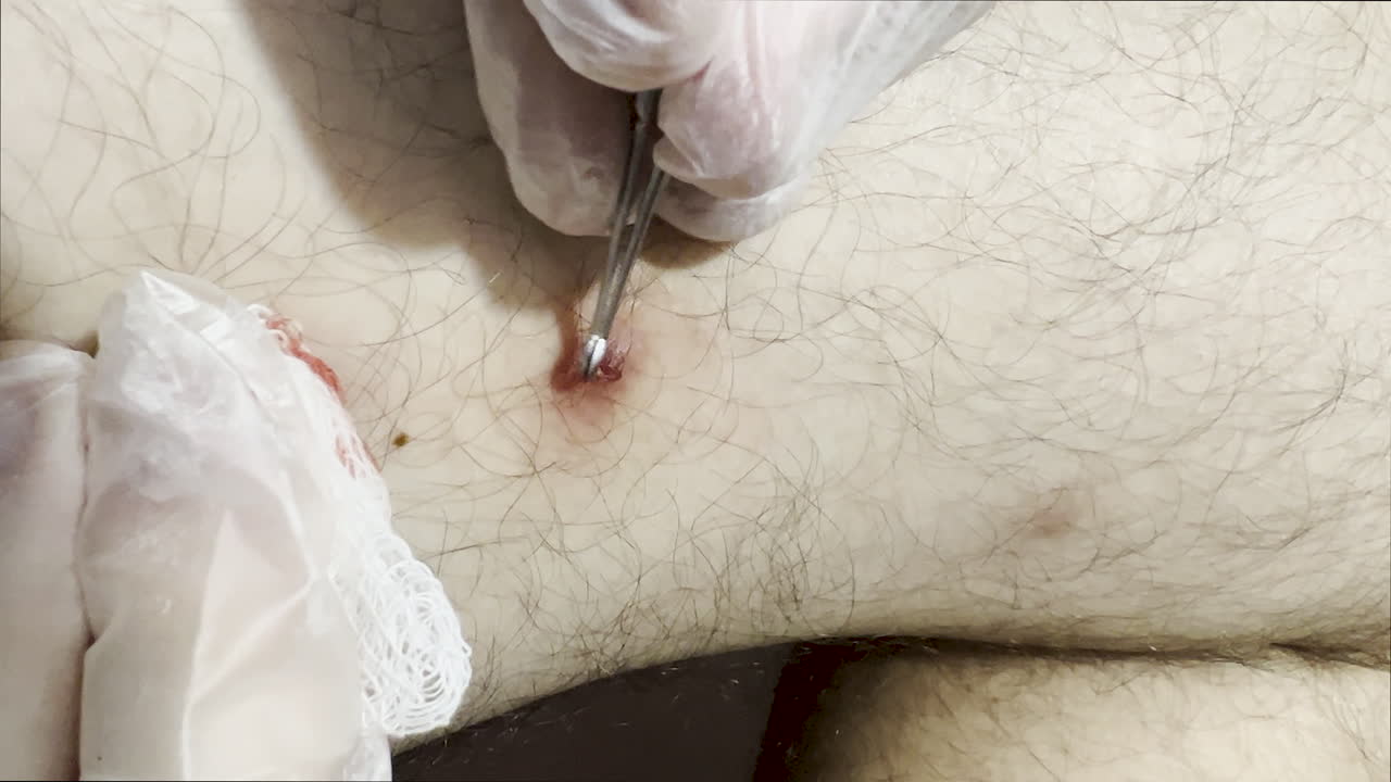 구부러진 핀세저로 내장된 털을 제거하는 여성 손의 세부 사항