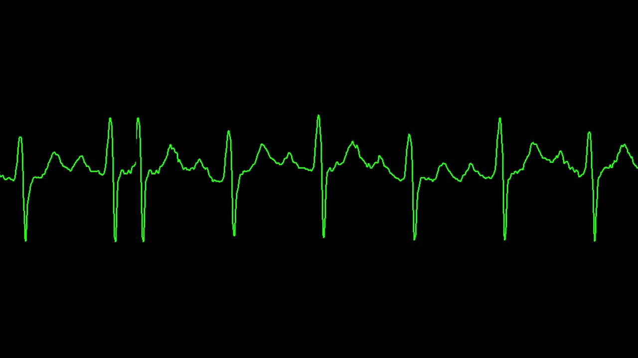 экг показывает синусовую тахикардию