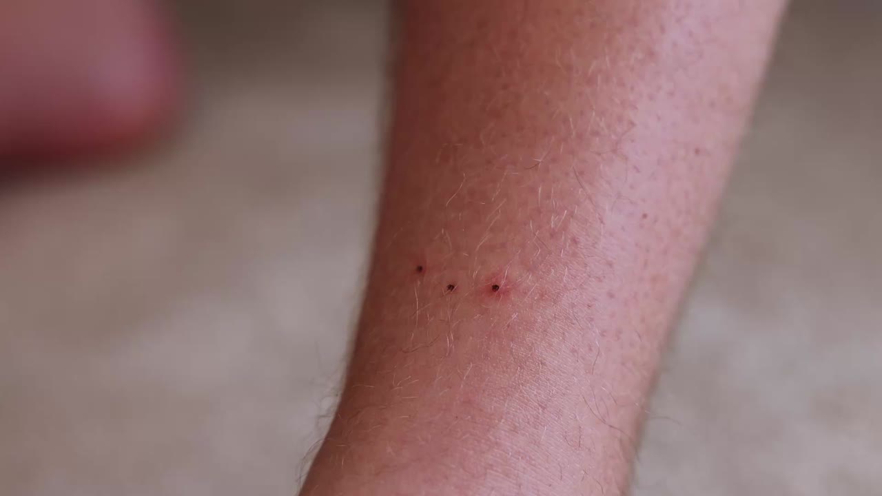 multiple ticks lodged into a mans leg with the potential of transferring Lymes Disease