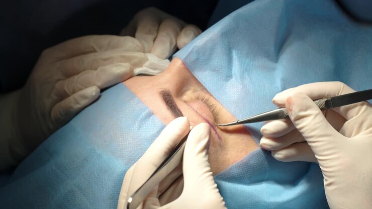 Blepharoplasty plastic surgery operation. Rejuvenation, modification the eye region