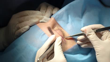 blepharoplasty plastic surgery operation. rejuvenation, modification the eye region