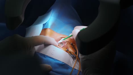 laser vision correction. a patient and team of surgeons in the operating room during ophthalmic surgery. eyelid speculum. lasik treatment. patient under sterile cover