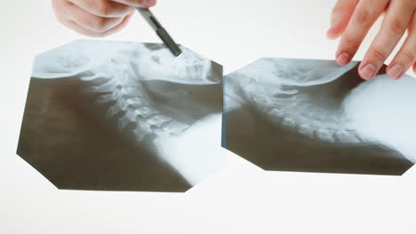doctor examining x-ray films of a human spine