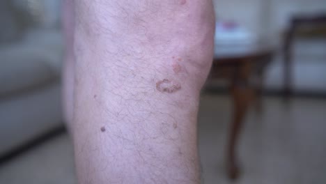 A-viral-wart-on-a-man's-leg