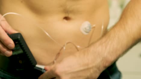 hombre diabético con una bomba de insulina conectada en su abdomen y sosteniendo la bomba de insulina en sus manos. concepto de diabetes.