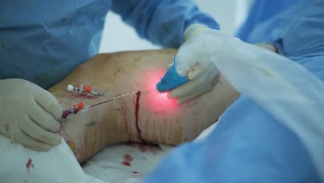 leg ulcer wound in treatment for varicose veins in phlebology procedure. bonding of veins using bioglue