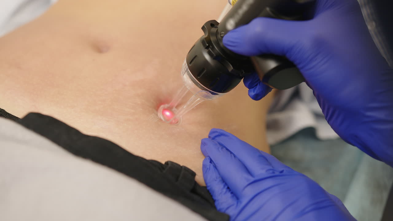 tratamiento con láser en el abdomen