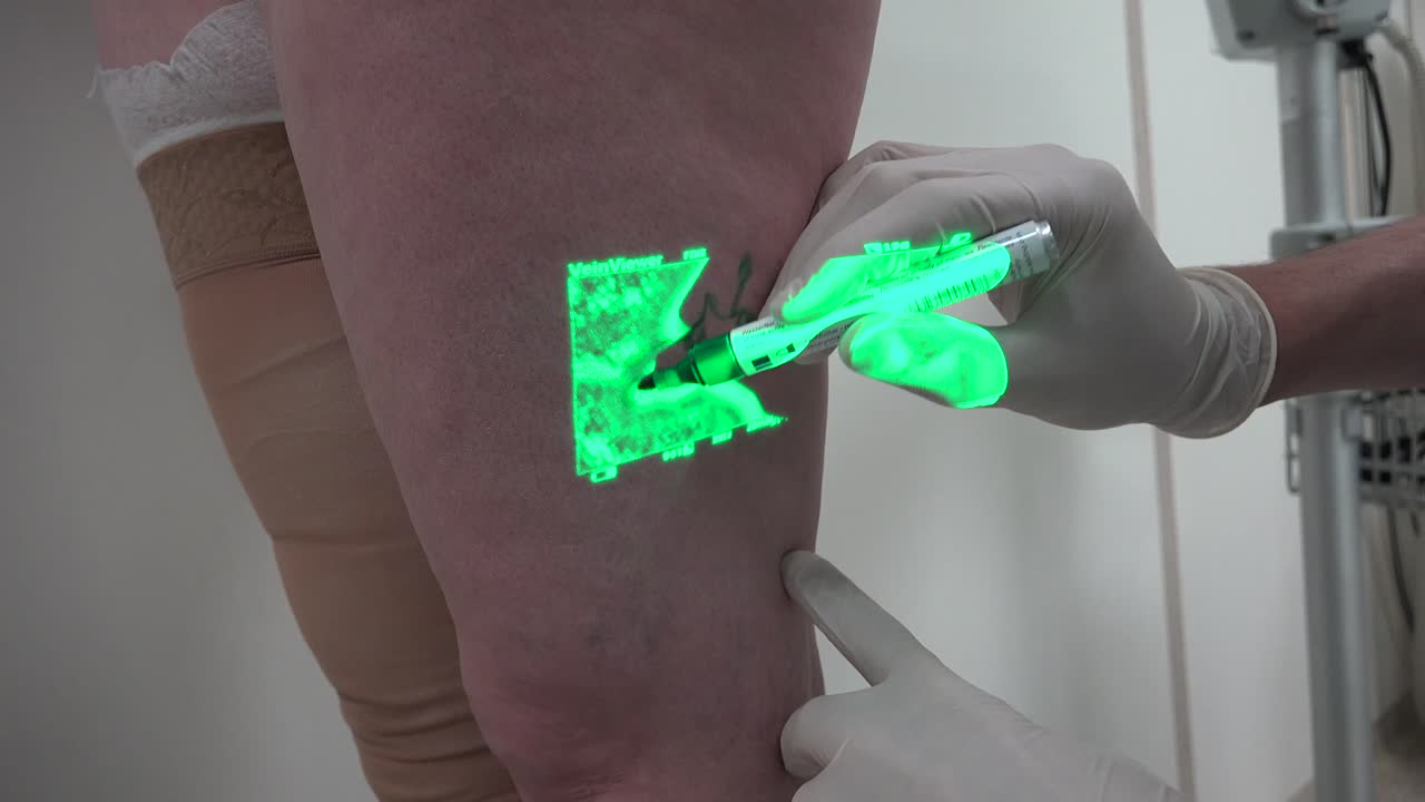 혈관 외과 의사는 정맥을 염증으로 표시하고 있습니다.