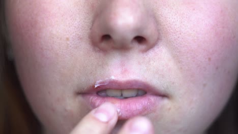 close-up of a person's mouth with a sore and ointment applied