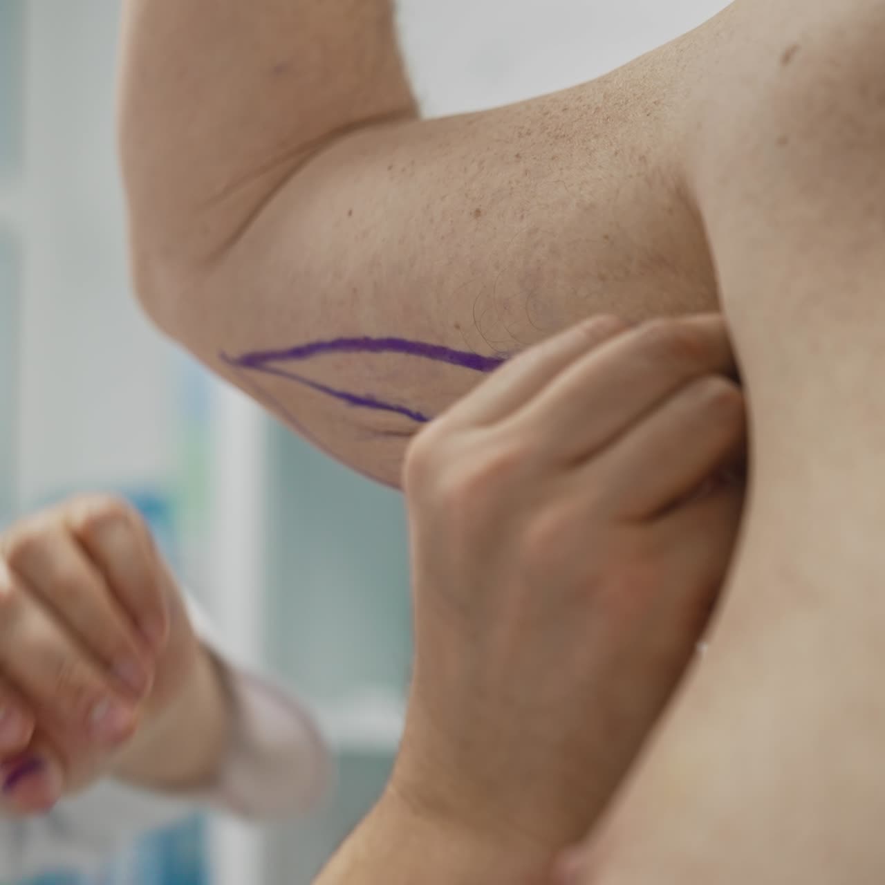 Professional doctor prepares patient's arm for plastic surgery. Surgeon marking a man's body before the liposuction. Result of weight loss