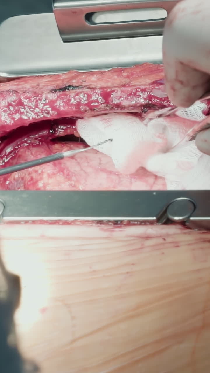 chirurgia cardiaca clinica con tecnologia laser. chirurgo mostra abilità abile nella chirurgia di bypass delle arterie coronarie con tecnologia laser all'avanguardia in ospedale