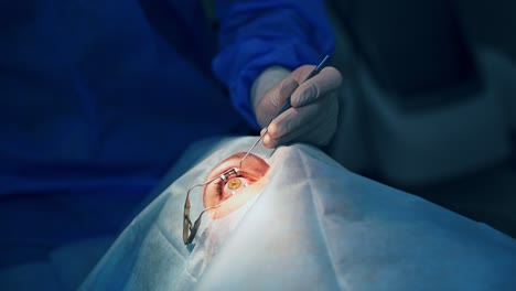 vision correction operation. surgeon's hands in gloves performing ophtalmology operation. modern clinic and equipment. selective video focus on the process.