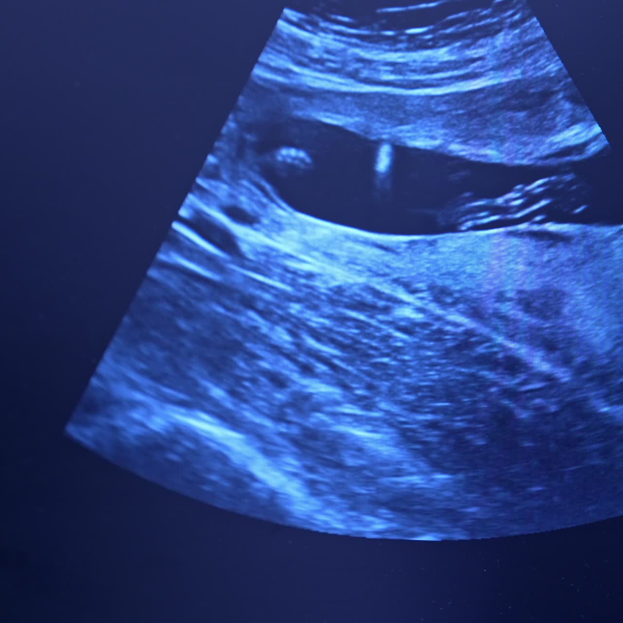 Screen of ultrasonic equipment showing the process of artificial extracorporeal fertilization in modern hospital. Close up