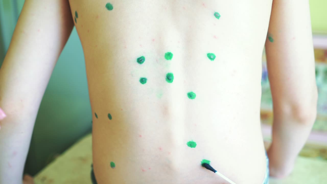 Baby with chicken pox. Close-up