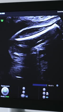 screen of an ultrasound machine during the pregnant female check. sonogram diagnostics for prenatal baby development. vertical video