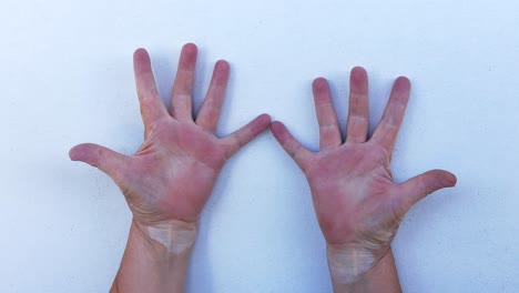 a middle-aged woman with skin condition of vitiligo