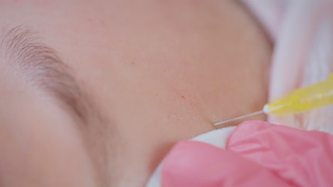 procedimiento de inyección facial