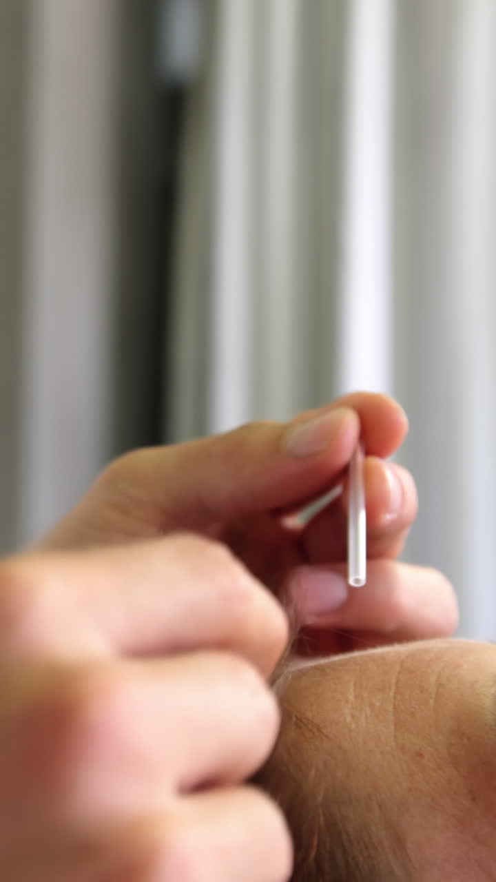 fisioterapeuta que da tratamiento de acupuntura a una paciente femenina