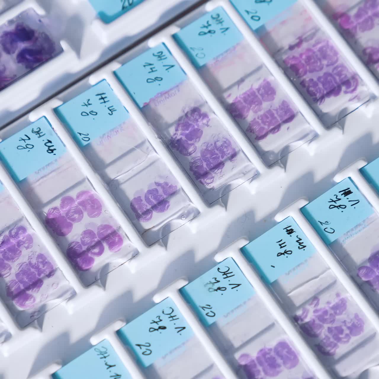 Test Samples In Medical Laboratory. Test samples of blood putting on the special glasses