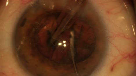 cirugía ocular, vitreoretinal, cirugía de vitrectomía.