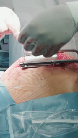el cirujano sella la capa facial con suturas. el médico experto cierra cuidadosamente la incisión del pecho usando suturas absorbibles terminando la cirugía de derivación de la arteria coronaria
