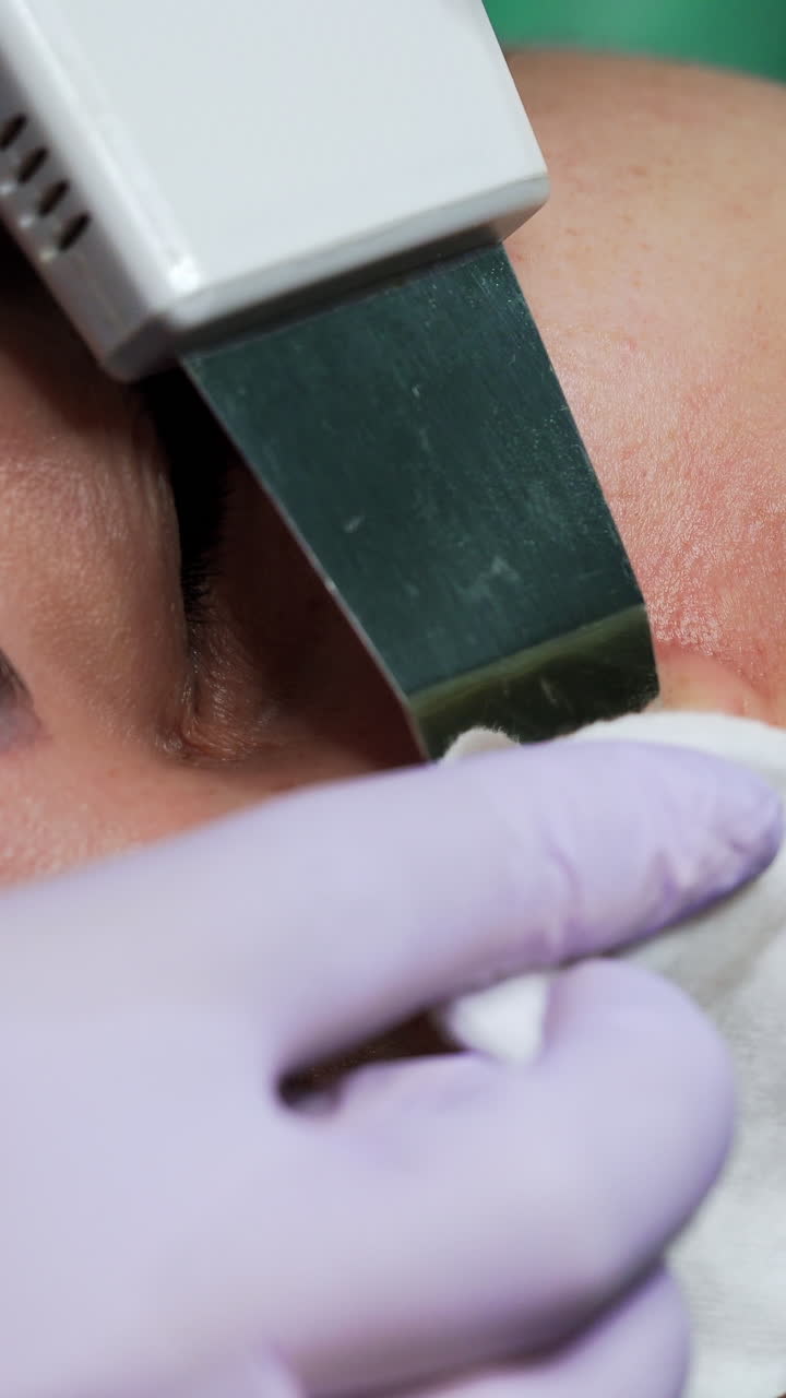Cosmetologist's hands in white gloves use the ultrasonic device in cosmetic procedures. Scrubber is applied to clean the area around nostrils. Extreme close up. Vertical video