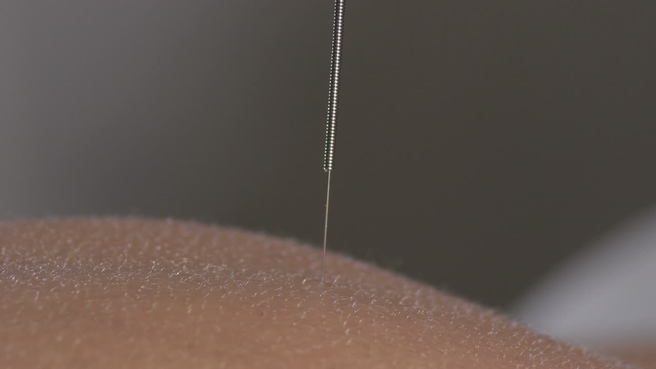 여성 환자 의 등 에 있는 침술 바늘