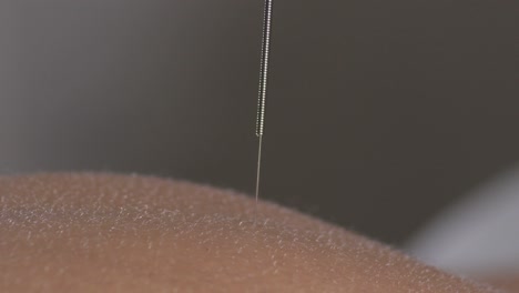 acupuncture needle on the back of a woman patient