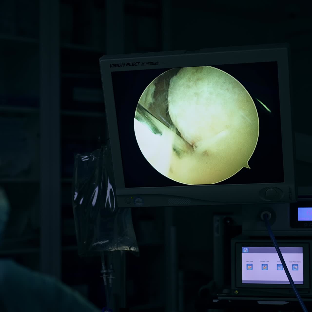 Laparoscopic operation in dark surgery room. Metal tool movement in operated area at the screen. Surgeons watching the procedure at monitor