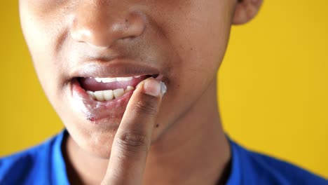close-up de uma pessoa a aplicar bálsamo labial a um lábio dolorido.