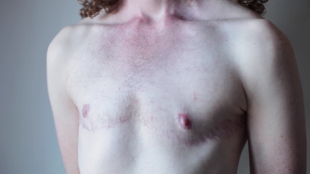 Transgender Man showing Surgery Scars on Chest