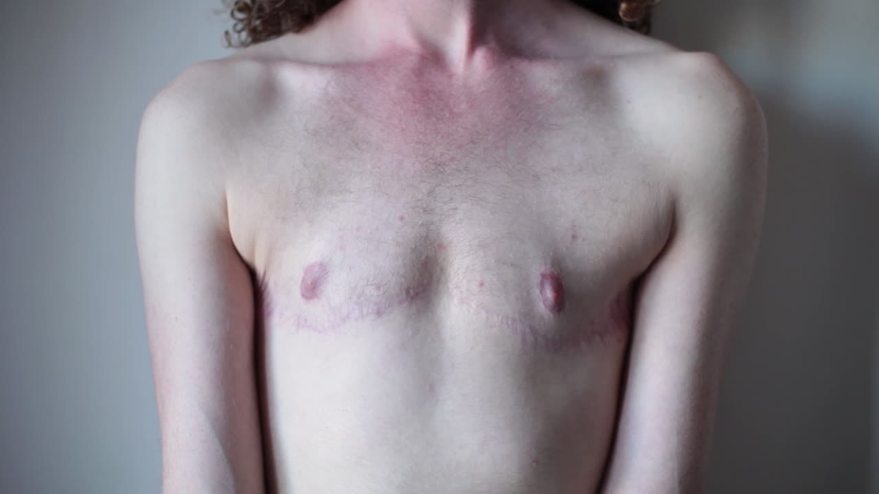 Transgender Man showing Surgery Scars on Chest