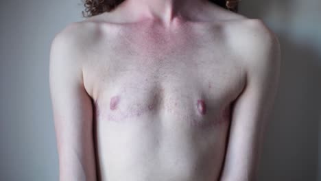 transgender man showing surgery scars on chest
