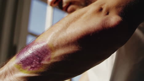 bruised arm