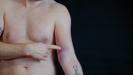 adult man without shirt indicating various areas of pain on left arm and shoulder after rupturing biceps.